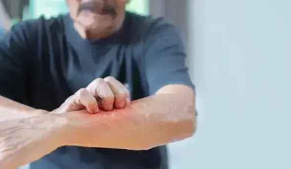 Prévention contre la gale